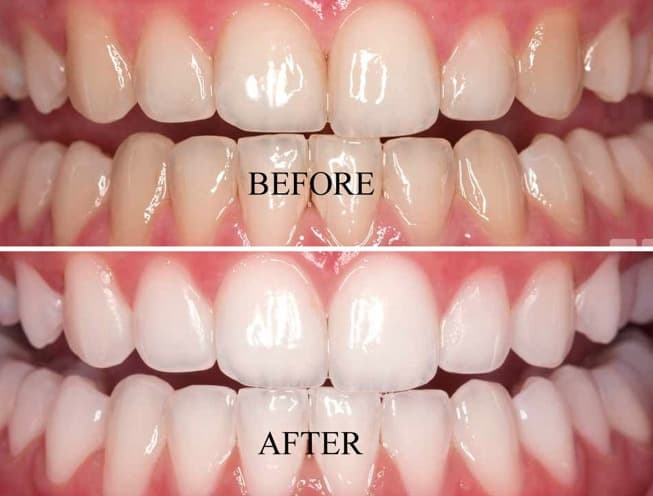 Before and after dental treatment result
